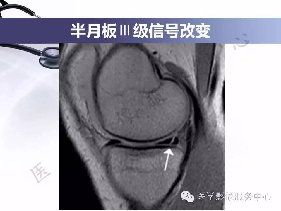 半月板病变的MRI诊断，如此精彩岂能错过！