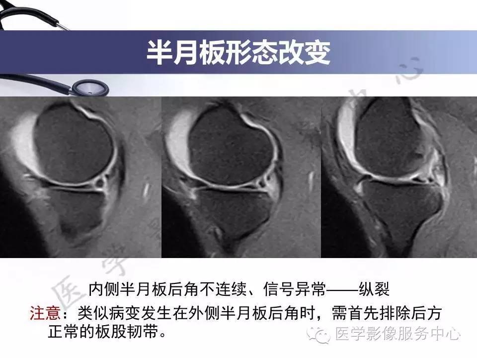 半月板病变的MRI诊断，如此精彩岂能错过！