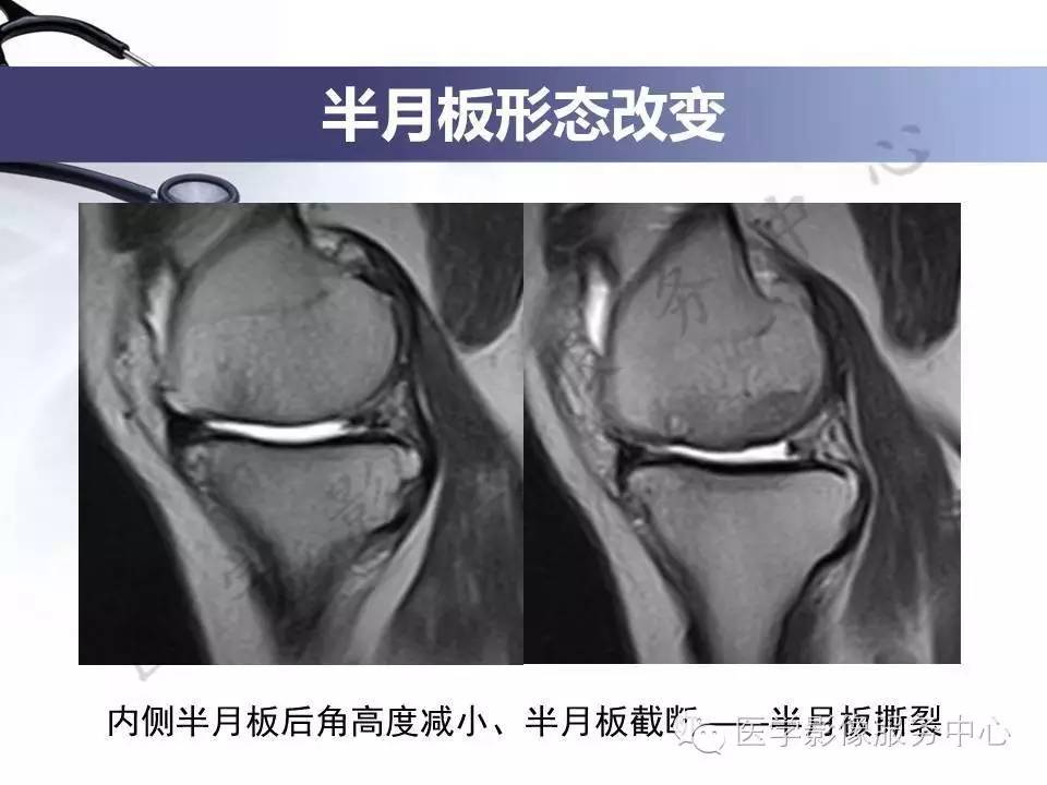 半月板病变的MRI诊断，如此精彩岂能错过！