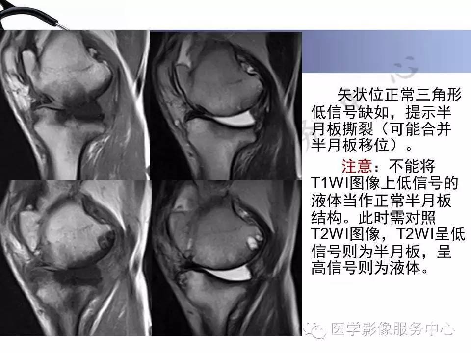 半月板病变的MRI诊断，如此精彩岂能错过！