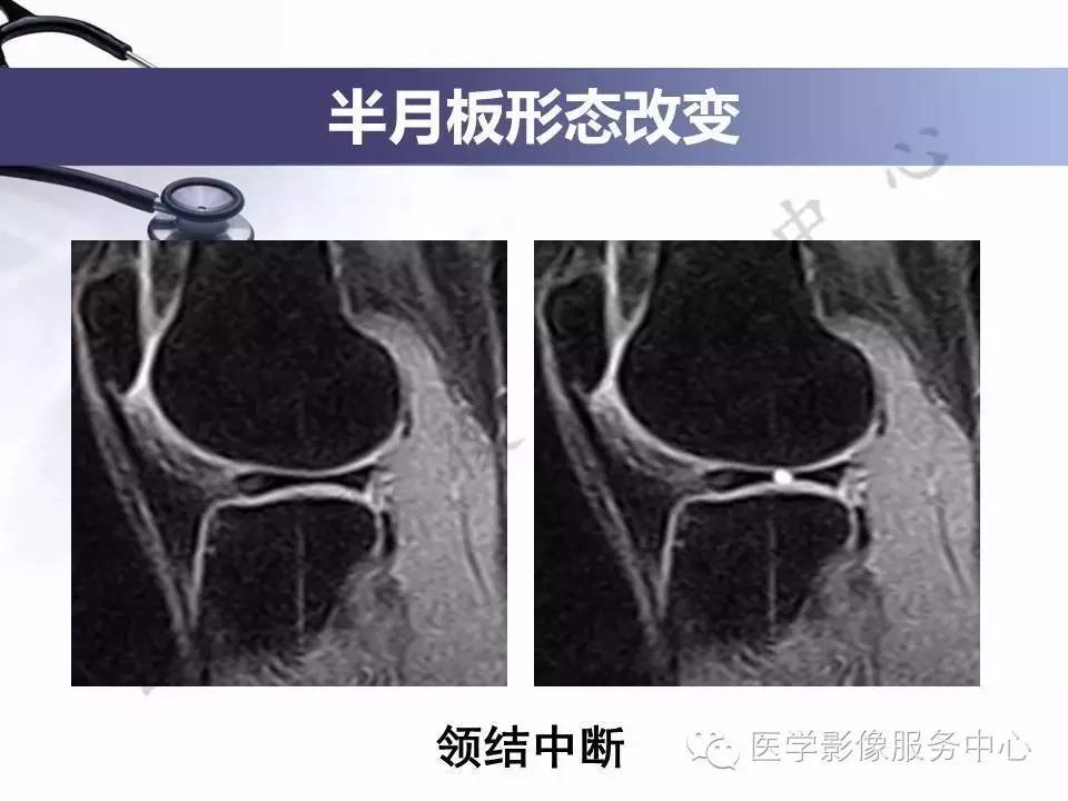 半月板病变的MRI诊断，如此精彩岂能错过！