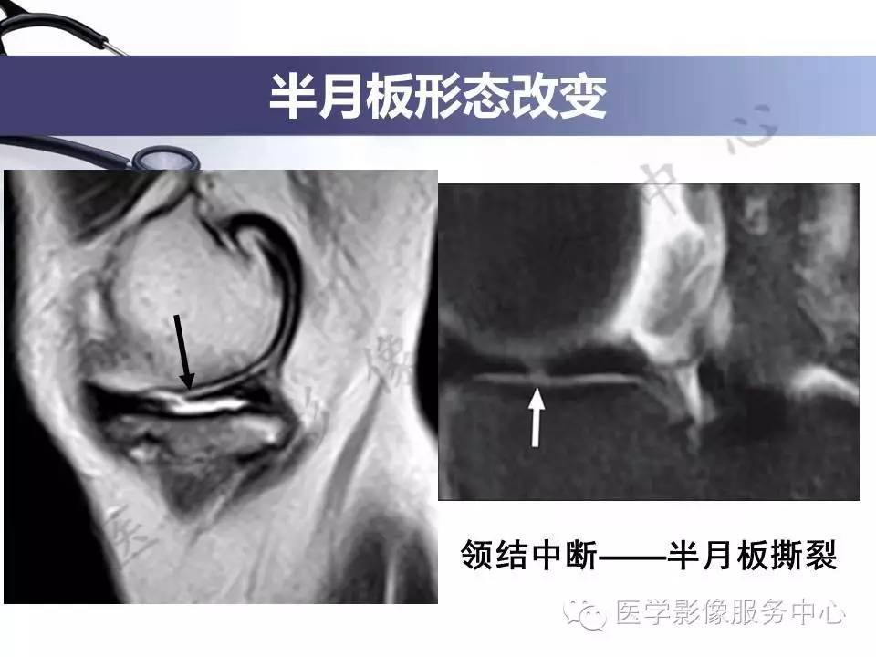 半月板病变的MRI诊断，如此精彩岂能错过！