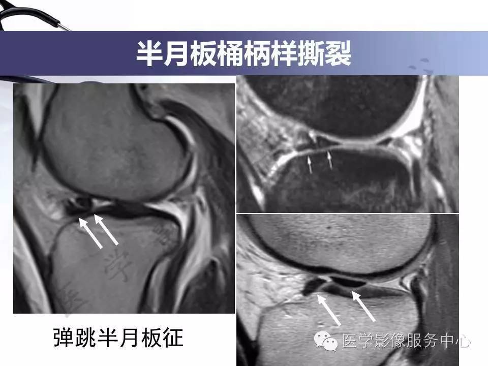 半月板病变的MRI诊断，如此精彩岂能错过！