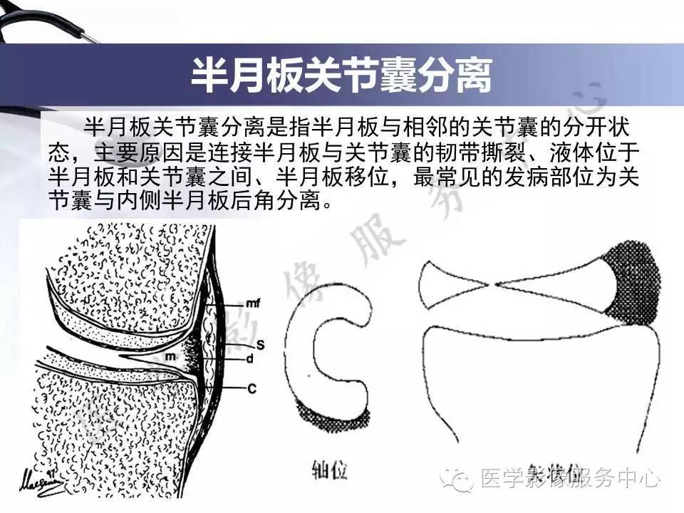 半月板病变的MRI诊断，如此精彩岂能错过！