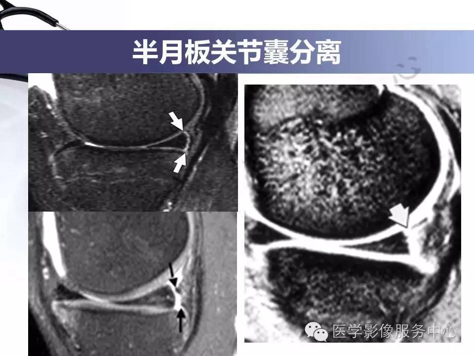 半月板病变的MRI诊断，如此精彩岂能错过！