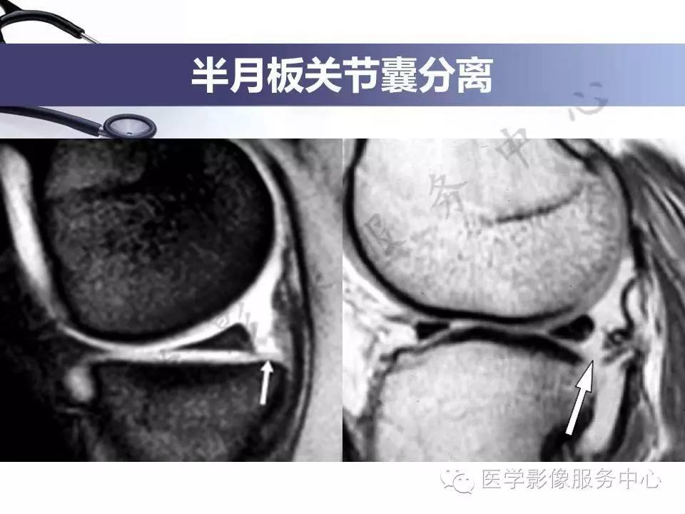 半月板病变的MRI诊断，如此精彩岂能错过！