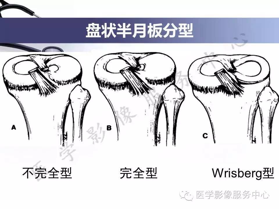 半月板病变的MRI诊断，如此精彩岂能错过！