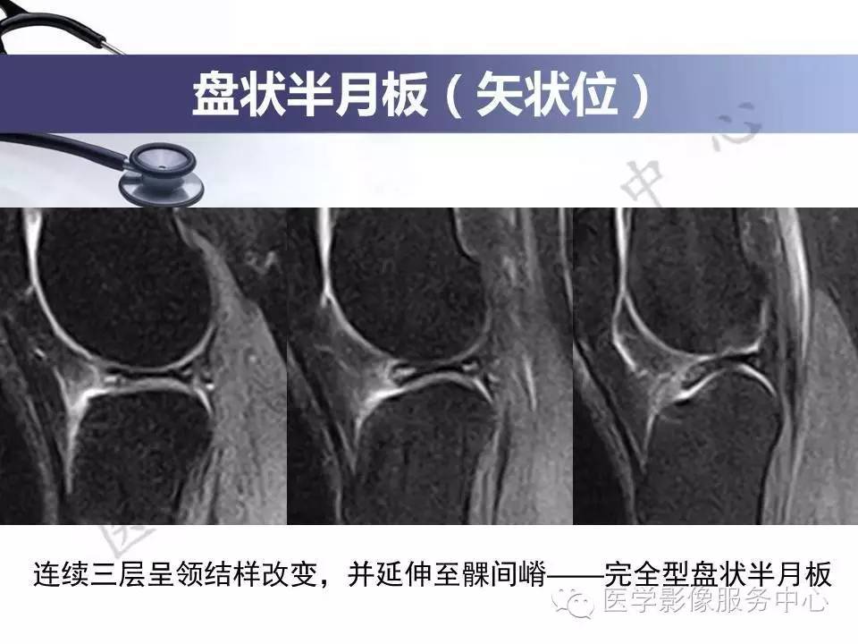 半月板病变的MRI诊断，如此精彩岂能错过！