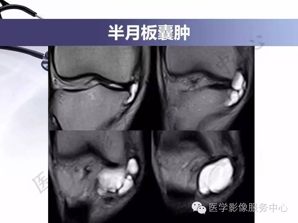 半月板病变的MRI诊断，如此精彩岂能错过！