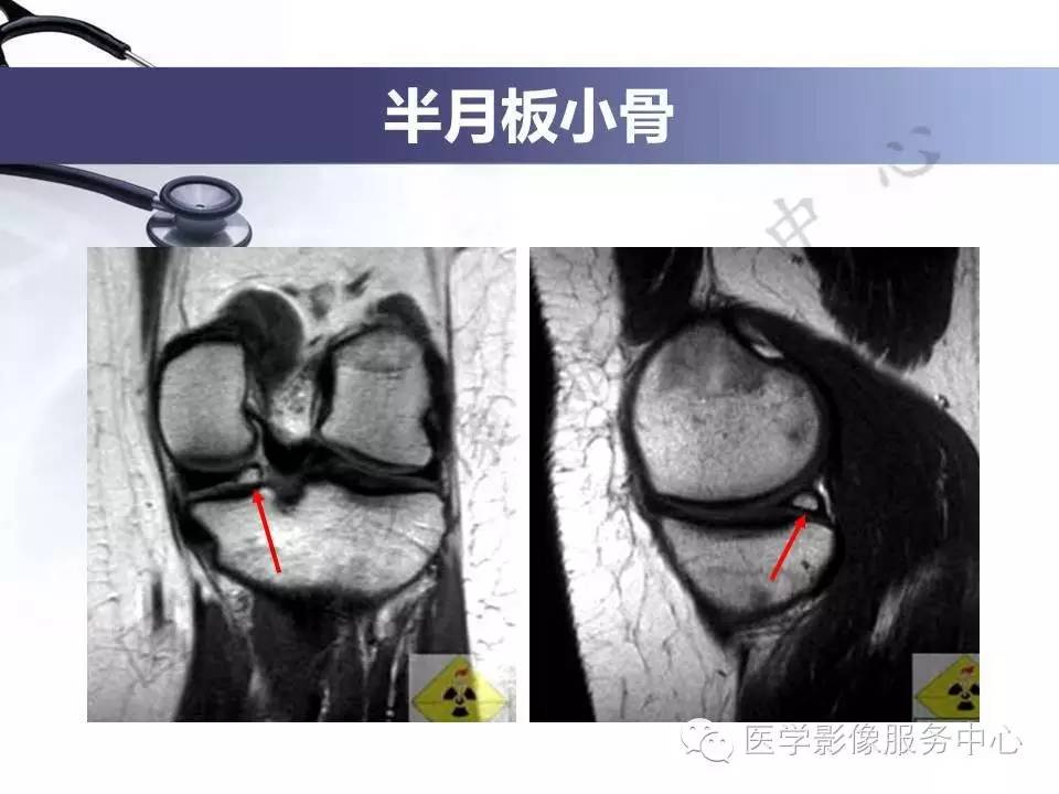 半月板病变的MRI诊断，如此精彩岂能错过！