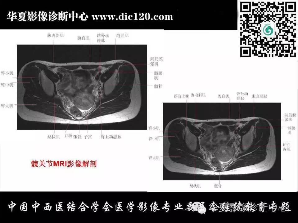 髋关节常见疾病的影像诊断