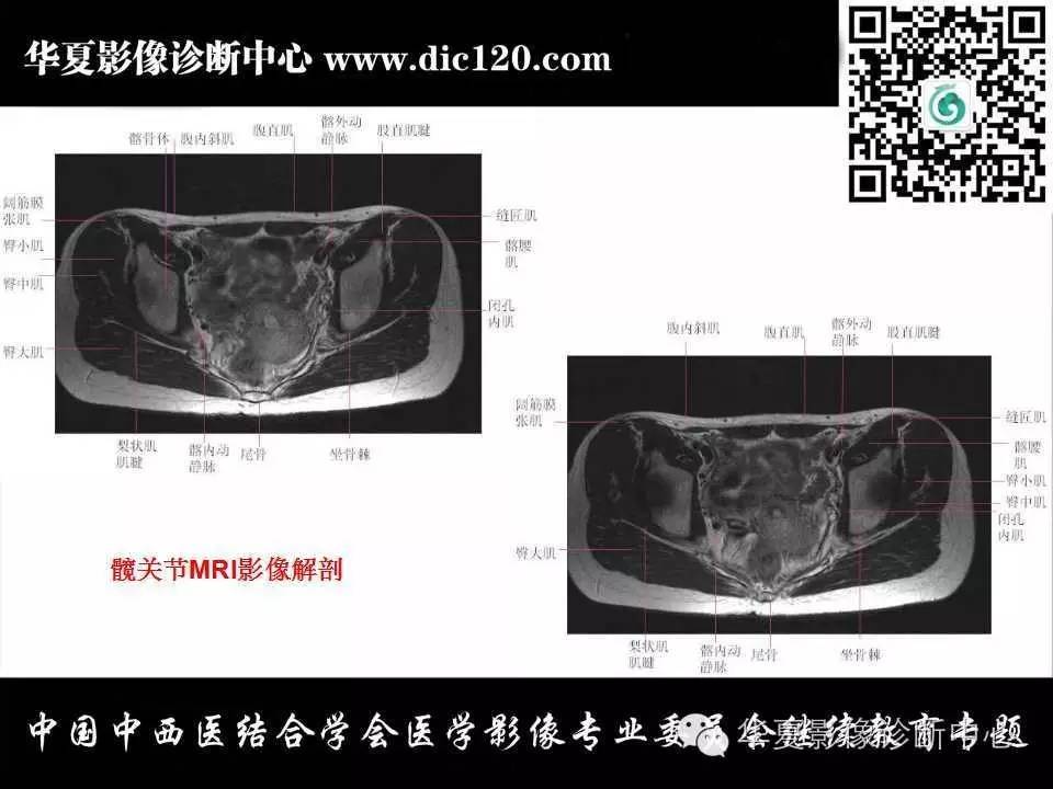 髋关节常见疾病的影像诊断