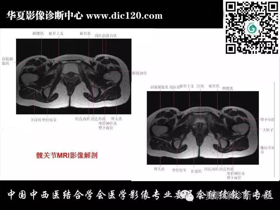 髋关节常见疾病的影像诊断