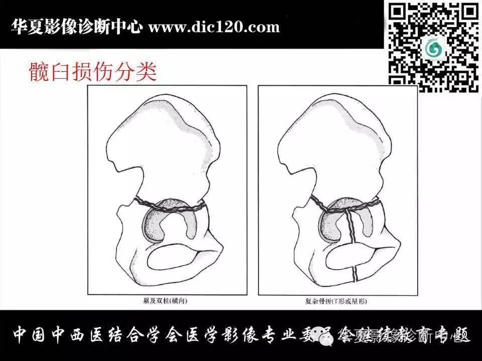 髋关节常见疾病的影像诊断