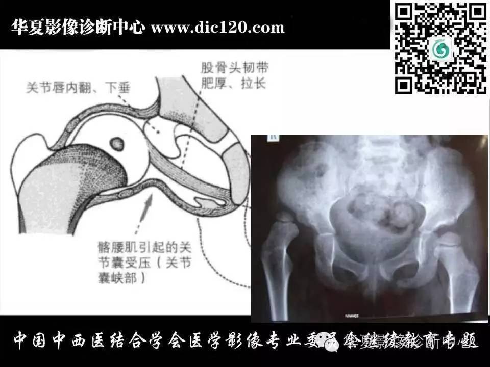 髋关节常见疾病的影像诊断