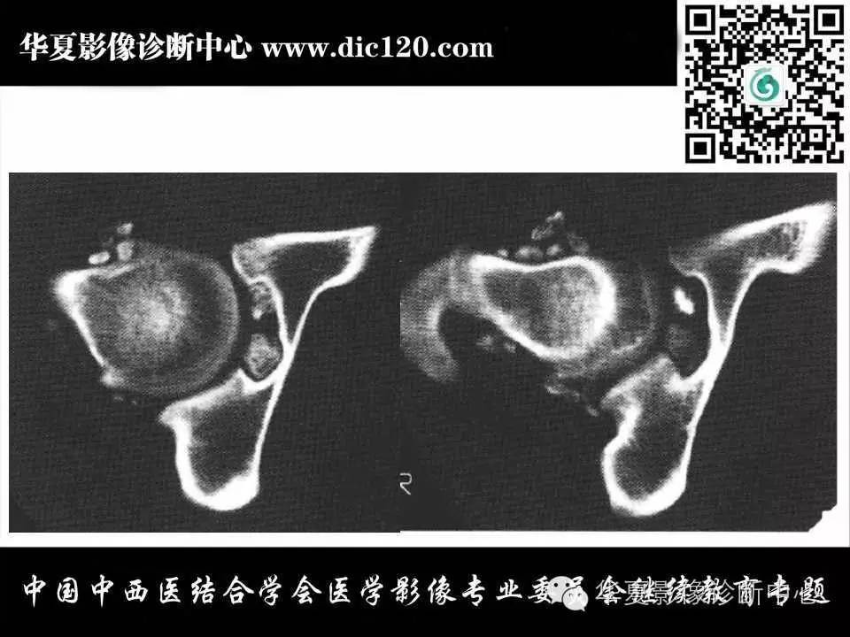 髋关节常见疾病的影像诊断