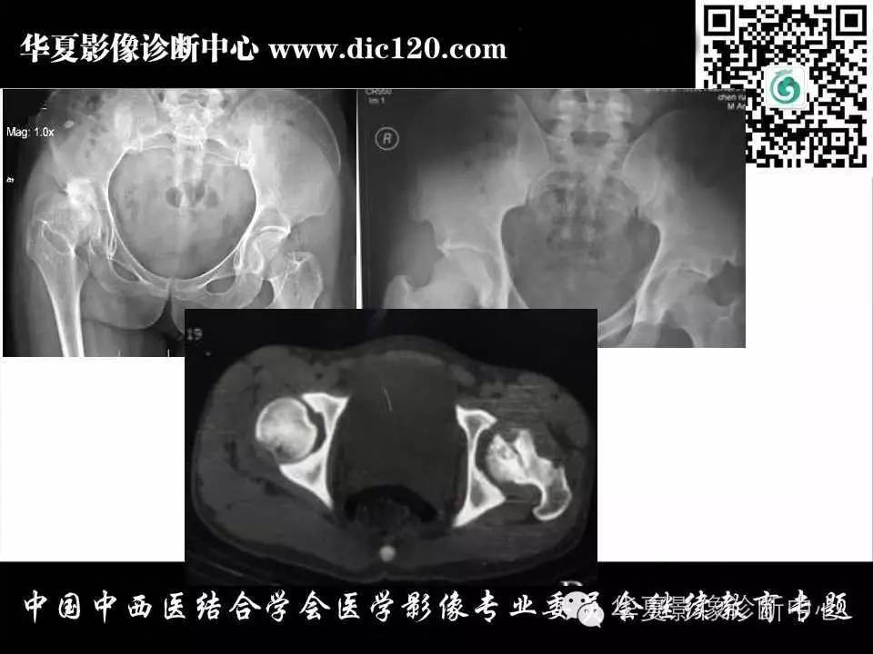 髋关节常见疾病的影像诊断