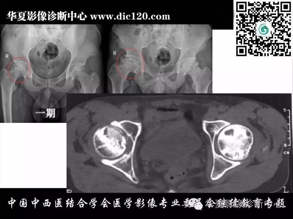 髋关节常见疾病的影像诊断