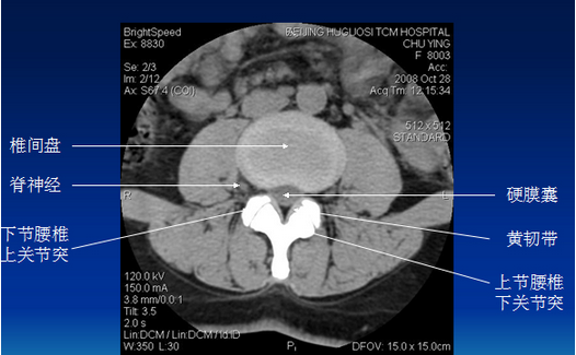腰椎CT诊断：椎间盘突出、椎管狭窄、退行性改变