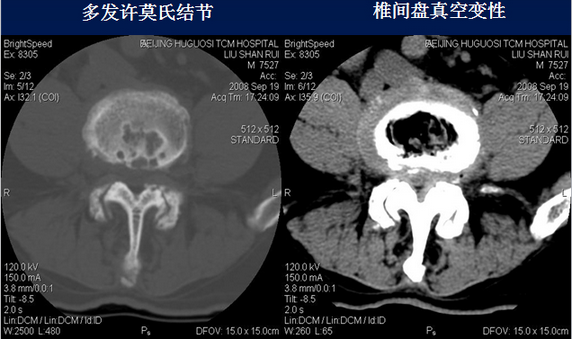 腰椎CT诊断：椎间盘突出、椎管狭窄、退行性改变