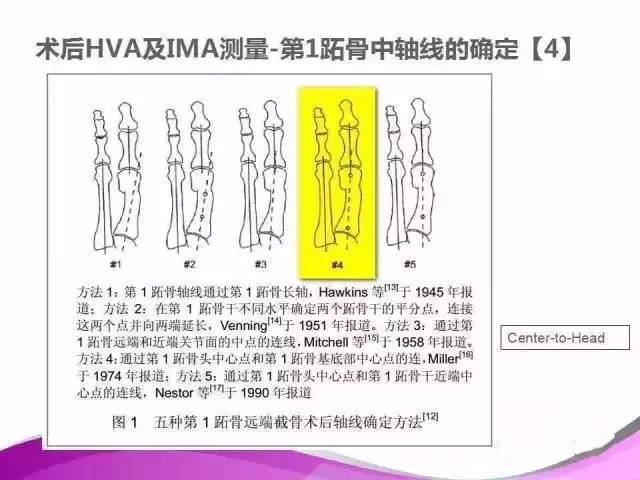 拇外翻X线测量评估及术式选择