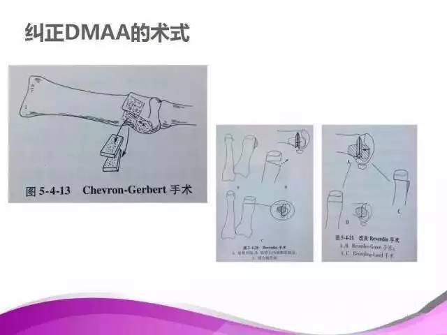 拇外翻X线测量评估及术式选择