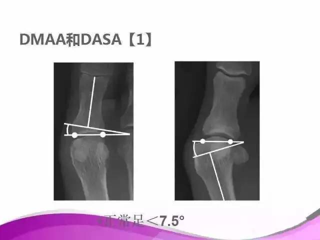 拇外翻X线测量评估及术式选择