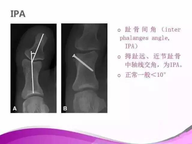 拇外翻X线测量评估及术式选择