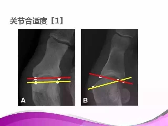 拇外翻X线测量评估及术式选择