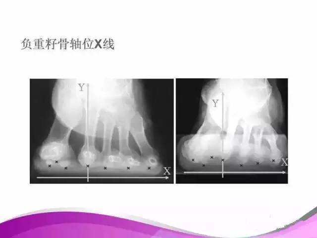 拇外翻X线测量评估及术式选择