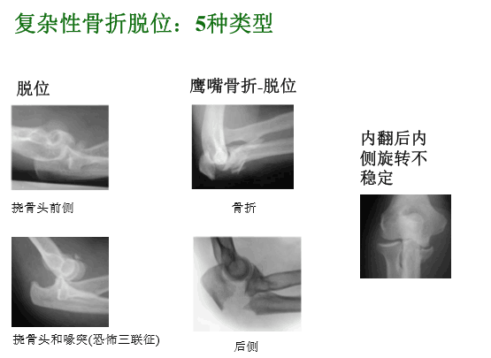 【2】荷兰最佳外科医生详细讲解“肘关节不稳定”