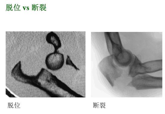 【2】荷兰最佳外科医生详细讲解“肘关节不稳定”