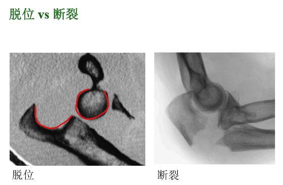 【2】荷兰最佳外科医生详细讲解“肘关节不稳定”