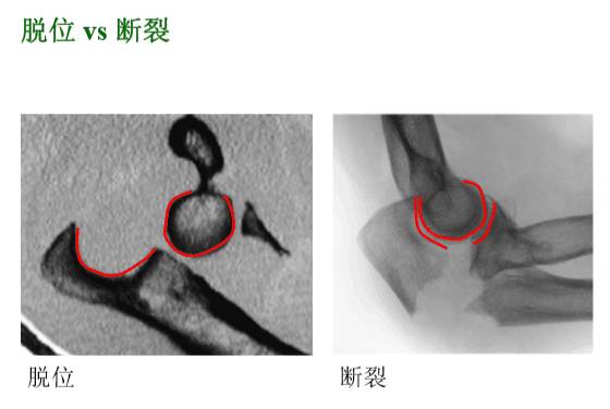 【2】荷兰最佳外科医生详细讲解“肘关节不稳定”