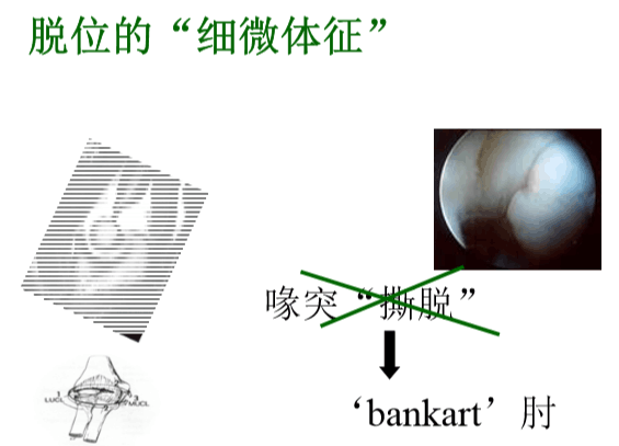 【2】荷兰最佳外科医生详细讲解“肘关节不稳定”