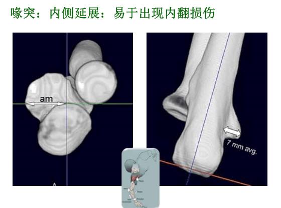 【2】荷兰最佳外科医生详细讲解“肘关节不稳定”