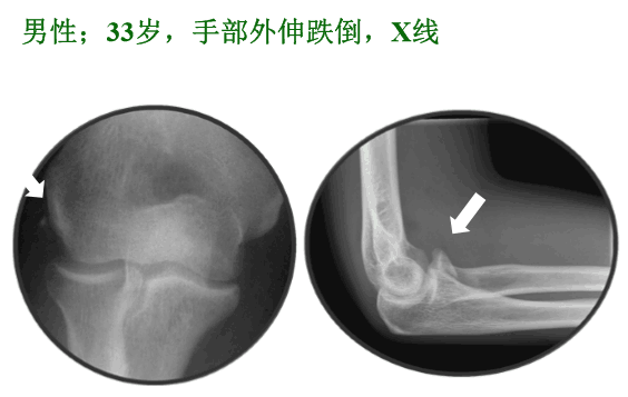 【2】荷兰最佳外科医生详细讲解“肘关节不稳定”