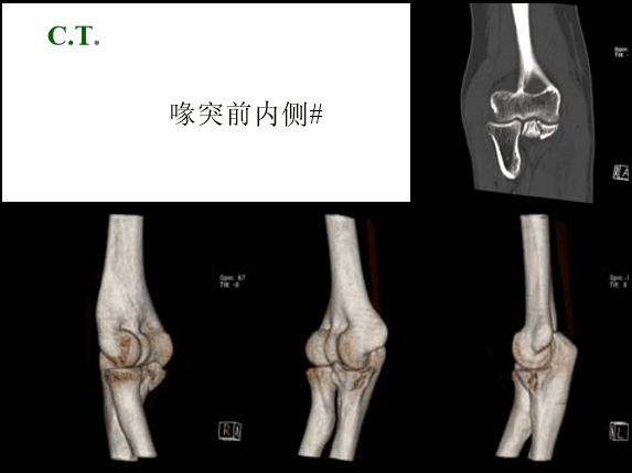 【2】荷兰最佳外科医生详细讲解“肘关节不稳定”