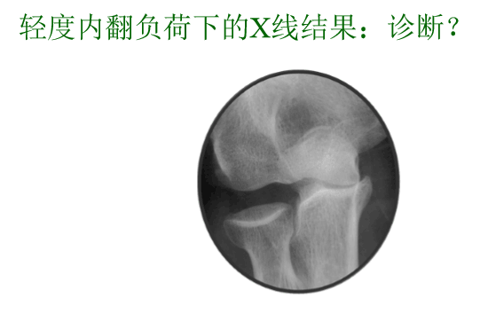 【2】荷兰最佳外科医生详细讲解“肘关节不稳定”