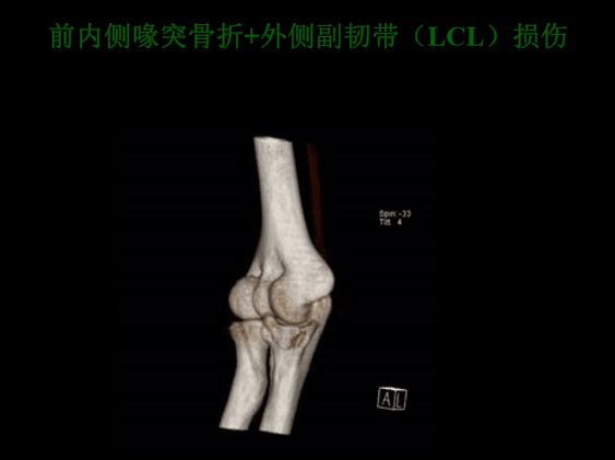 【2】荷兰最佳外科医生详细讲解“肘关节不稳定”