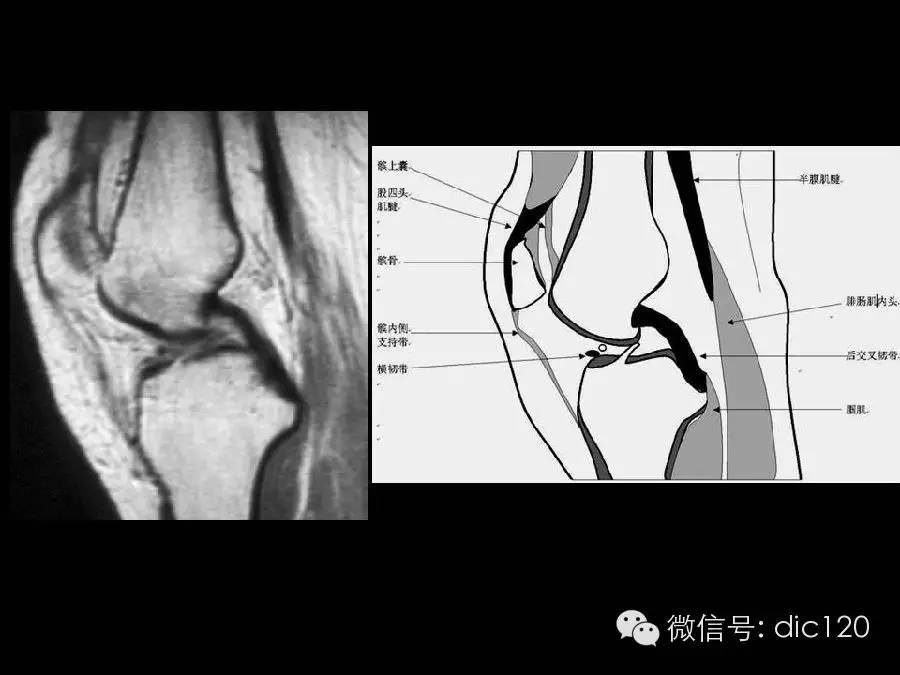 半月板和韧带MRI诊断