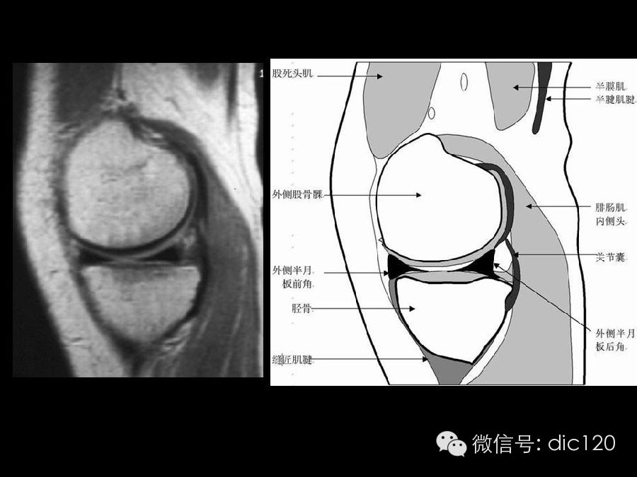 半月板和韧带MRI诊断