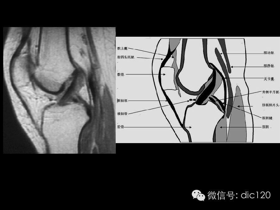 半月板和韧带MRI诊断