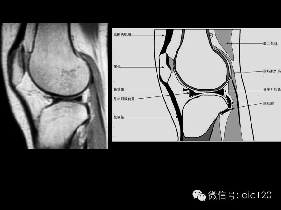 半月板和韧带MRI诊断