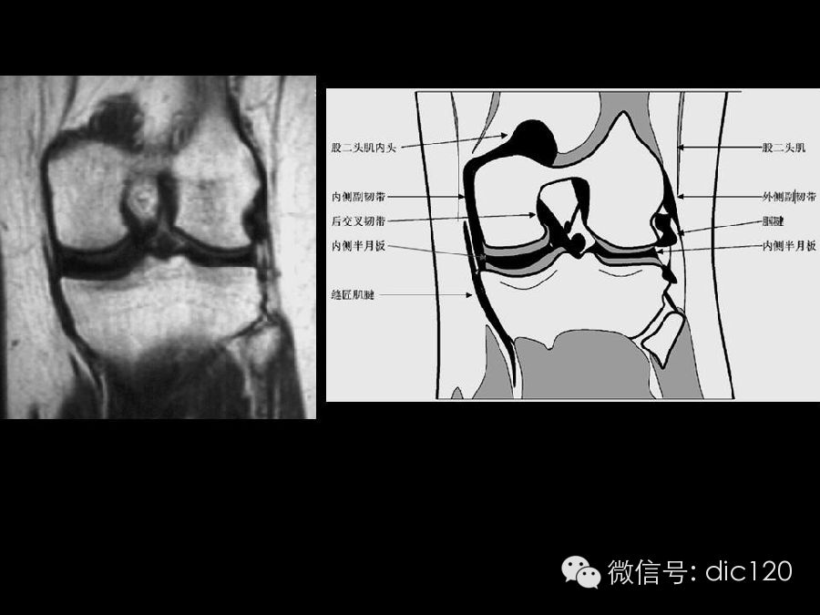 半月板和韧带MRI诊断