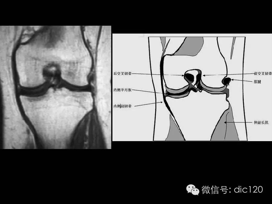 半月板和韧带MRI诊断