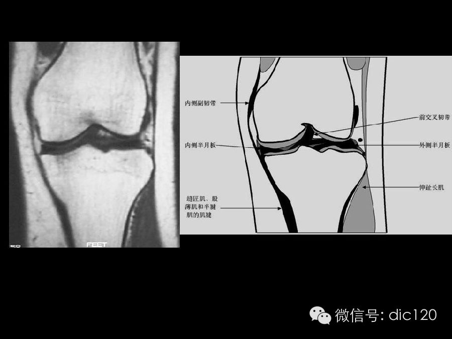 半月板和韧带MRI诊断