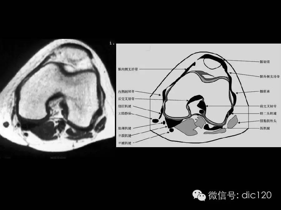 半月板和韧带MRI诊断