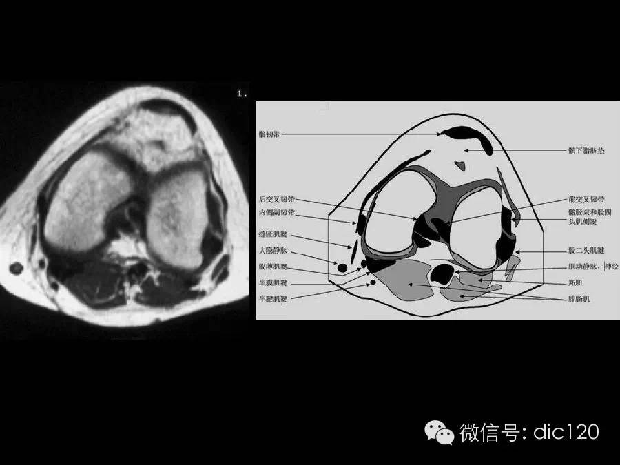 半月板和韧带MRI诊断