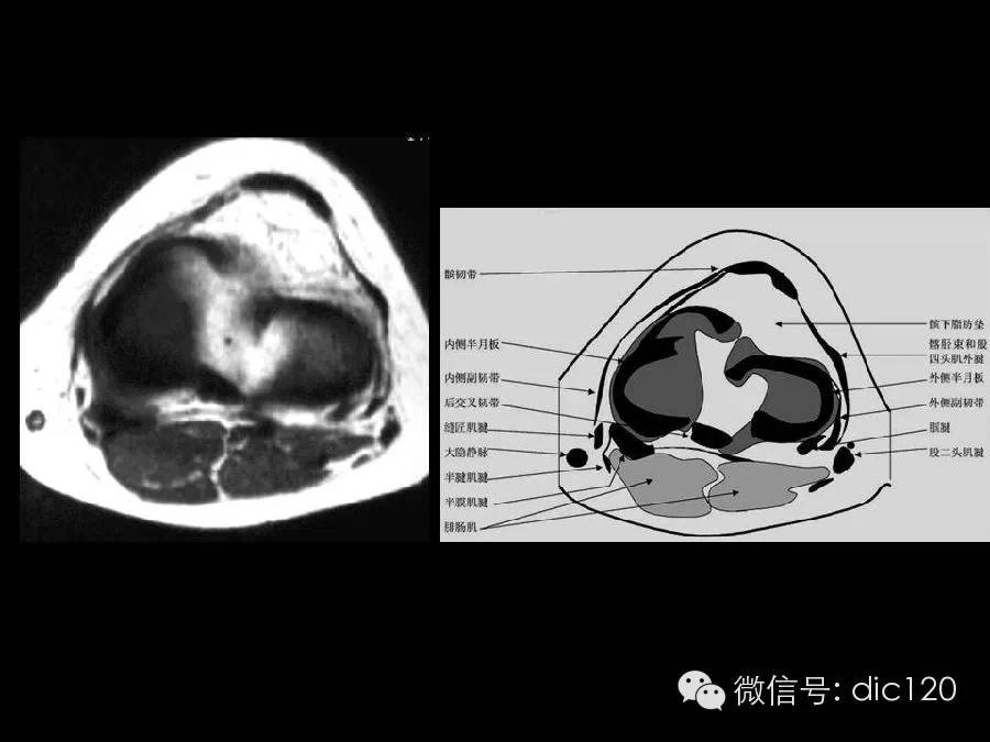 半月板和韧带MRI诊断